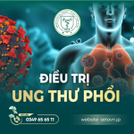 Điều Trị Ung Thư Phổi: Cập Nhật Phác Đồ & Xu Hướng Mới Nhất 2025 8 Điều trị ung thư phổi - SETA VIỆT NAM